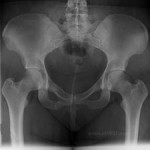 Hip Implant/ RxRecall/The Maher Law Firm